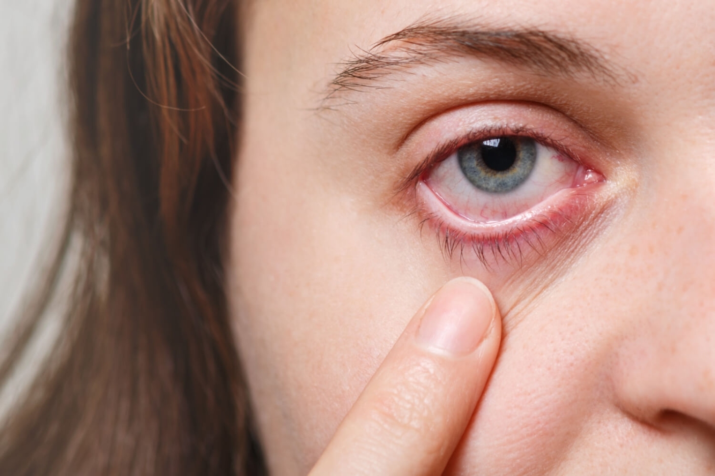Corneal abrasion example