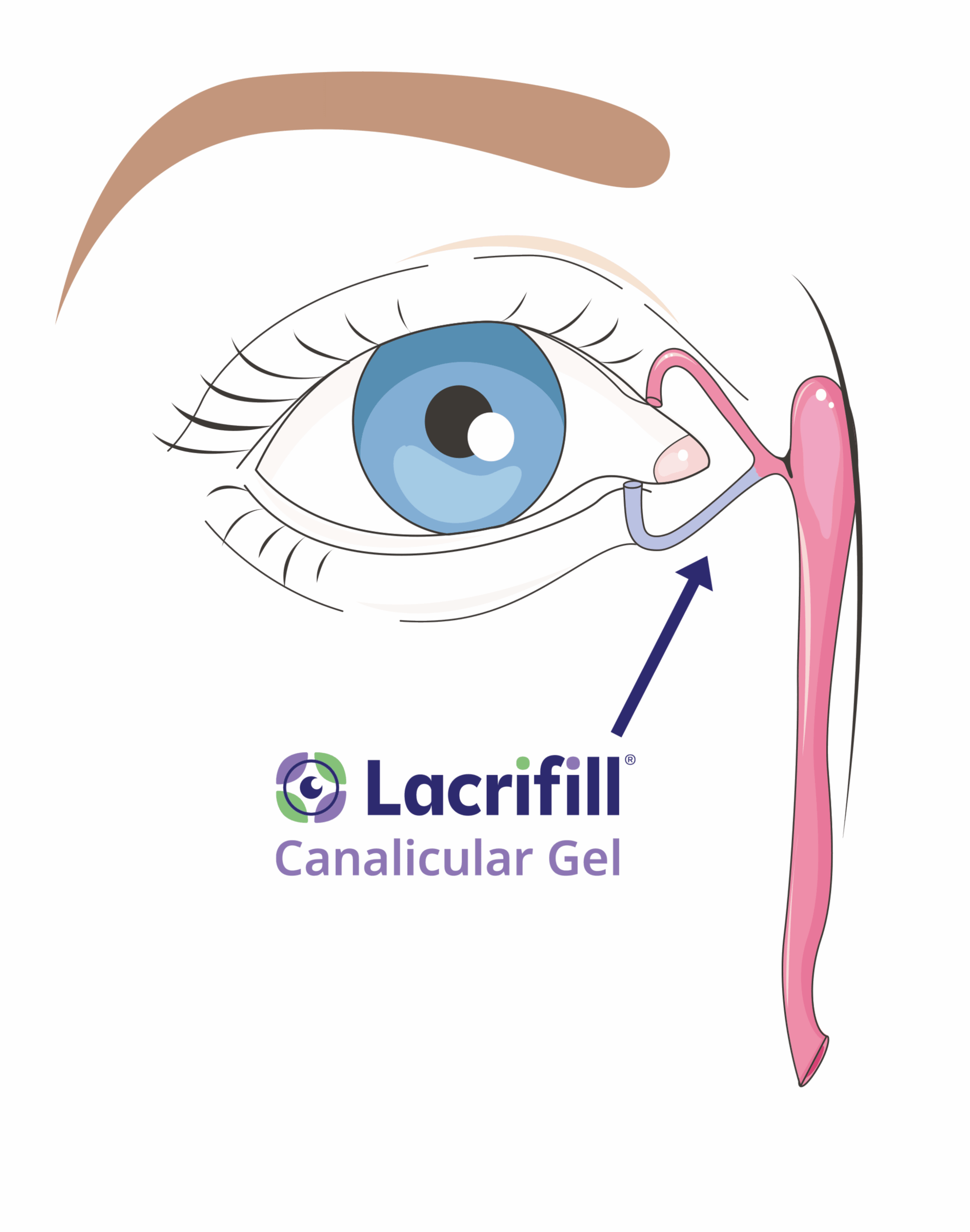 Diagram showing how Lacrifill canalicular gel works in the tear drainage system